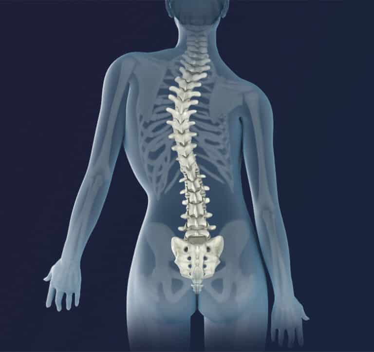 The Differences Between Kyphosis And Scoliosis | Custom Rehab PT