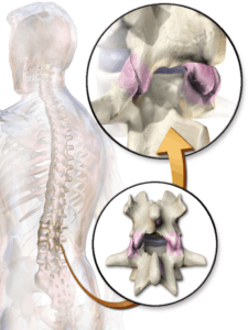 facet joint syndrome
