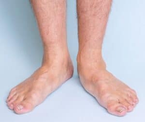 flat feet therapy