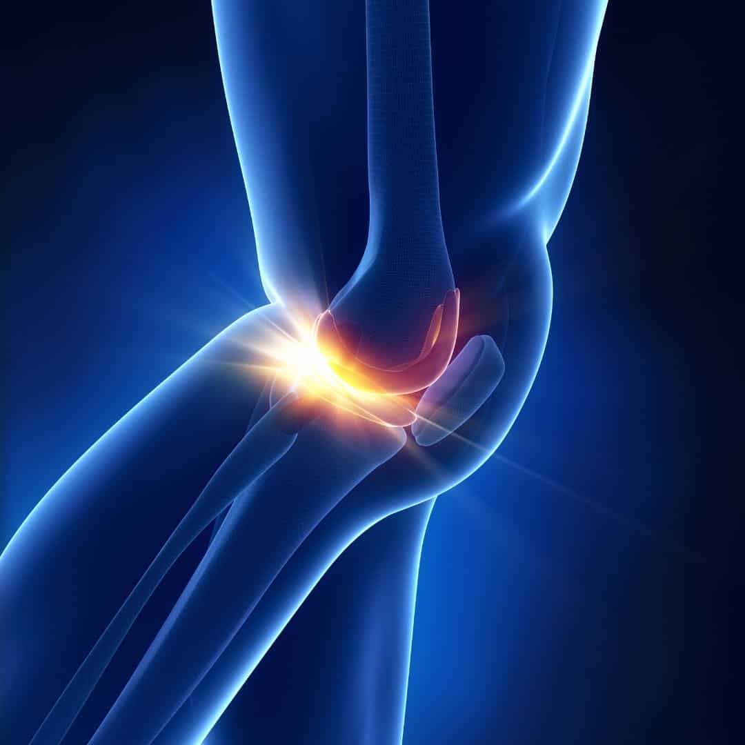 The Benefits of Physical Therapy for Meniscus Tears | Custom Rehab PT